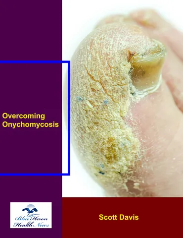 Overcoming Onychomycosis product image