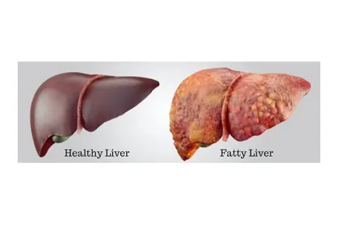Reverse Your Fatty Liver product image